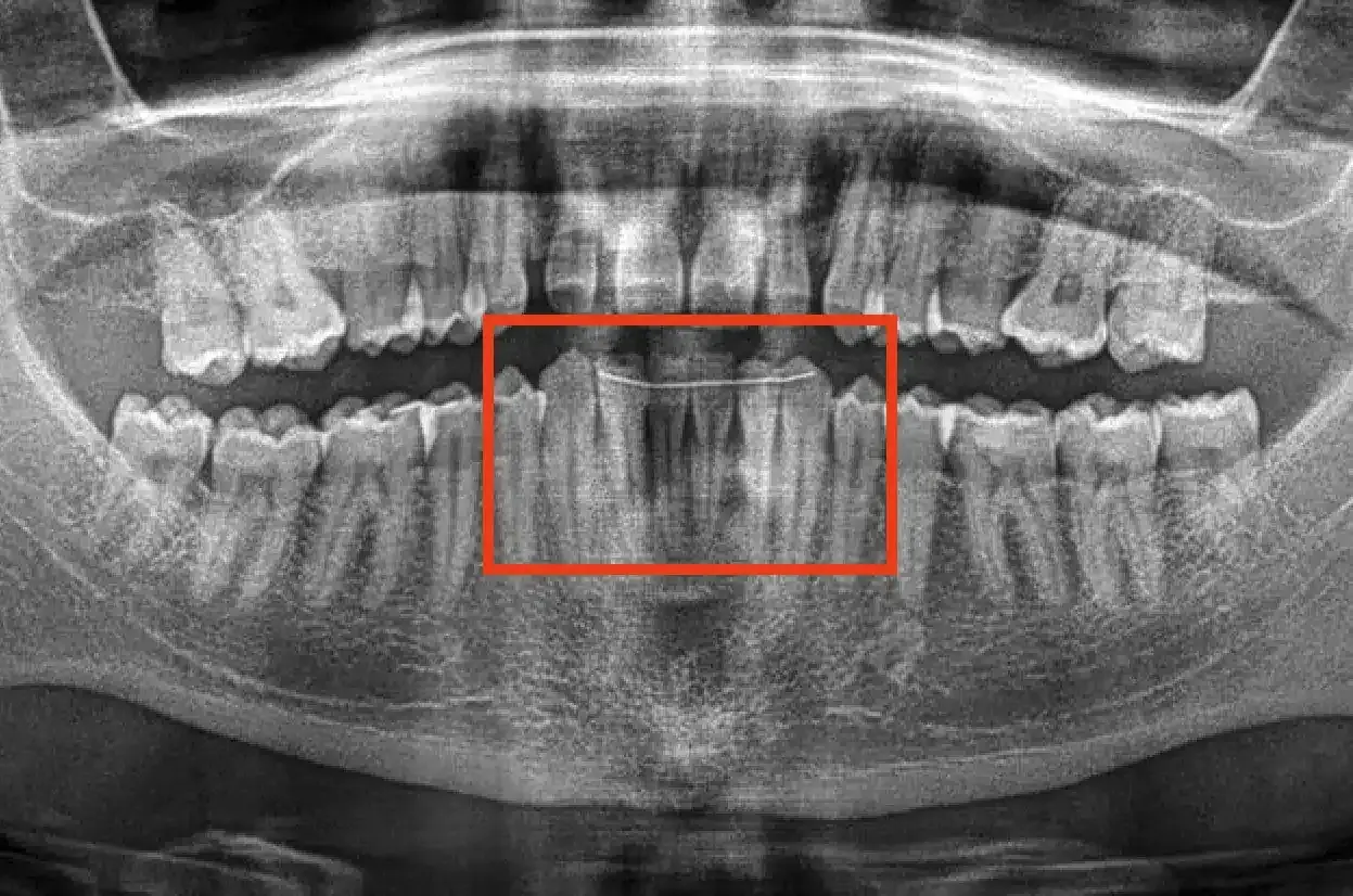Radiografia panoramica dei denti con un filo metallico che stabilizza i denti anteriori. Un dente che si muove si può salvare con cure adeguate.