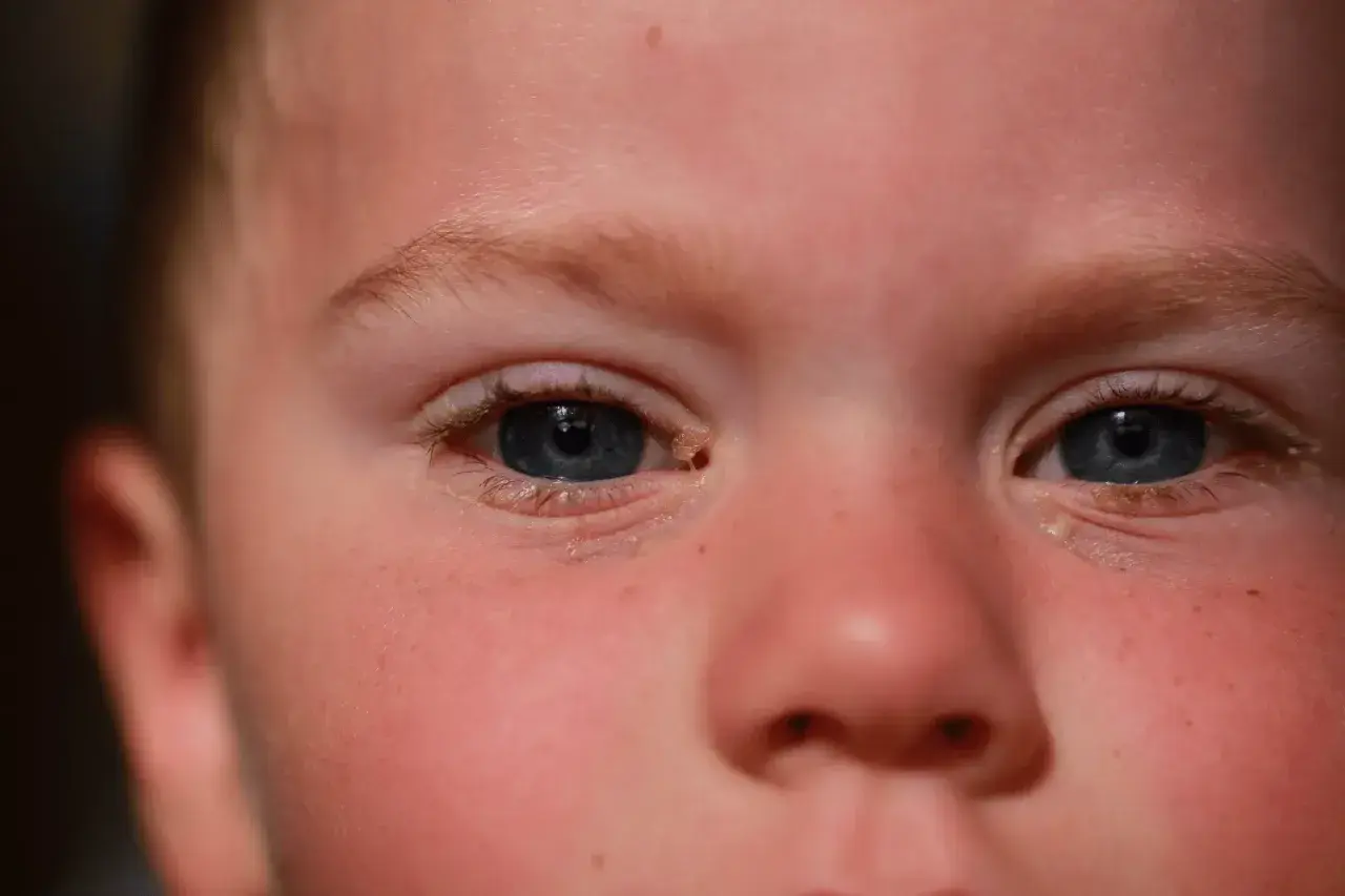 Ojos de niño con secreción, sugiriendo la necesidad de gotas para conjuntivitis en niños.