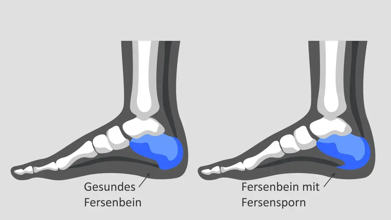 Vergleich von gesundem Fersenbein und Fersenbein mit oberem Fersensporn. Der Fersensporn ist als knöcherner Auswuchs am Fersenbein dargestellt.