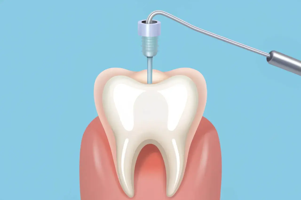 Ilustracja przedstawia narzędzie dentystyczne w zębie, symbolizujące potencjalne objawy stanu zapalnego po leczeniu kanałowym.