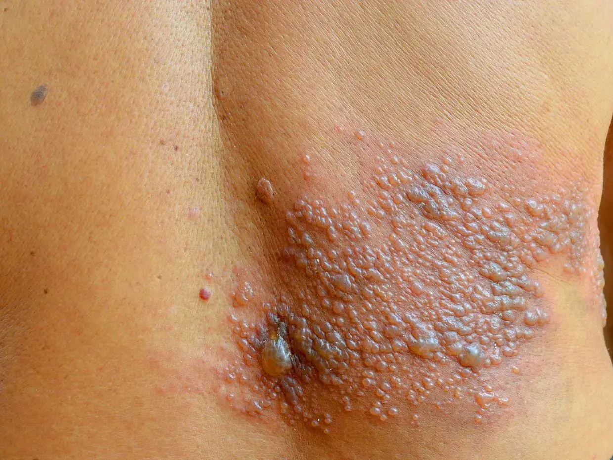 Eruzione cutanea con vescicole, simile al fuoco di Sant'Antonio, su un fianco. Non è comune nei bambini, ma può verificarsi.