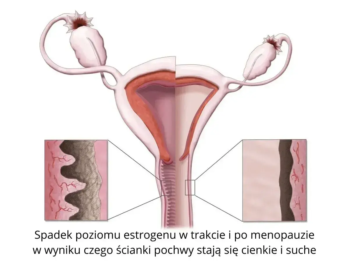 Ilustracja pokazuje zmiany w pochwie podczas menopauzy, prowadzące do suchości pochwy.