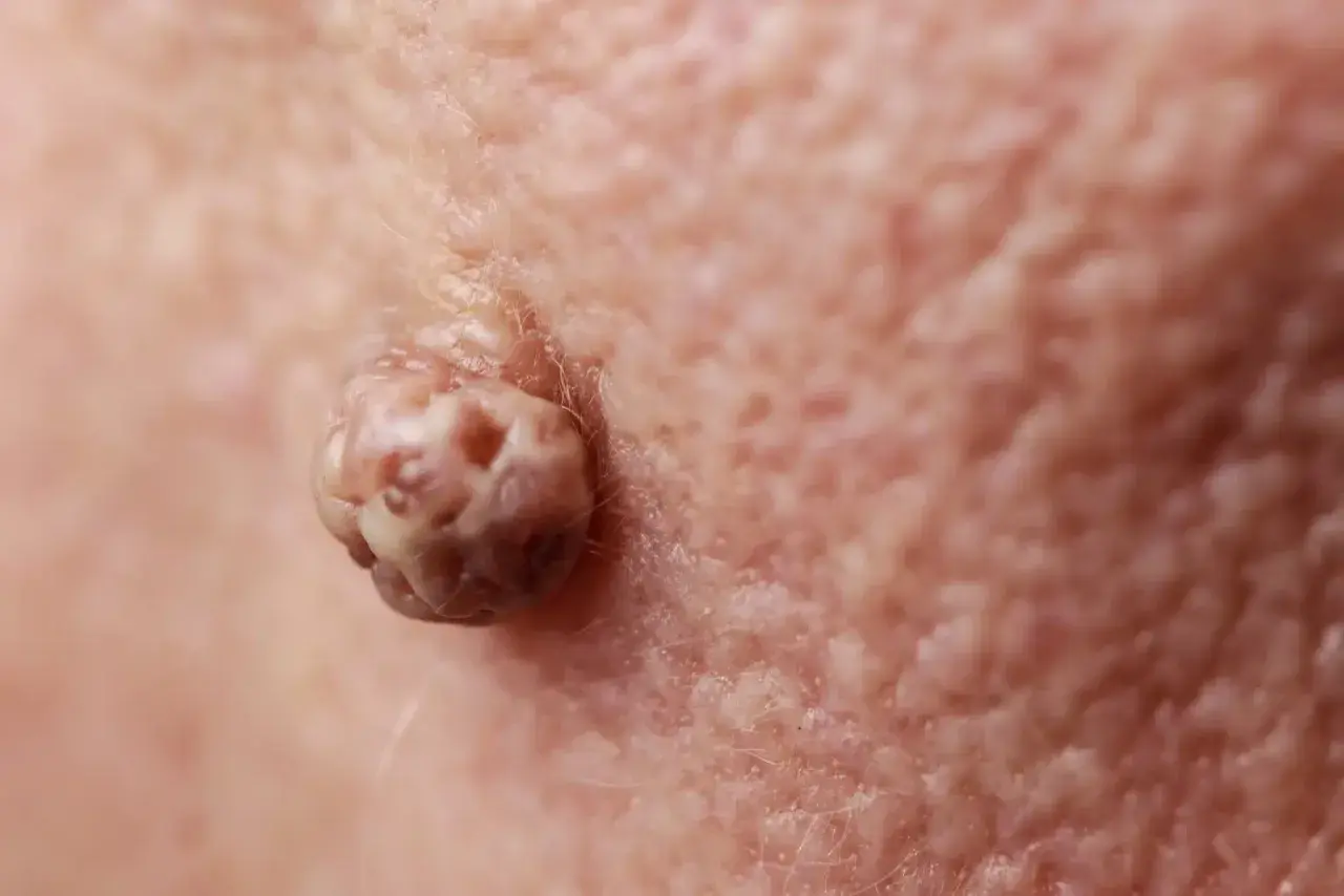 Gros plan d'un acrochordon douloureux sur la peau, texture rugueuse et irrégulière.