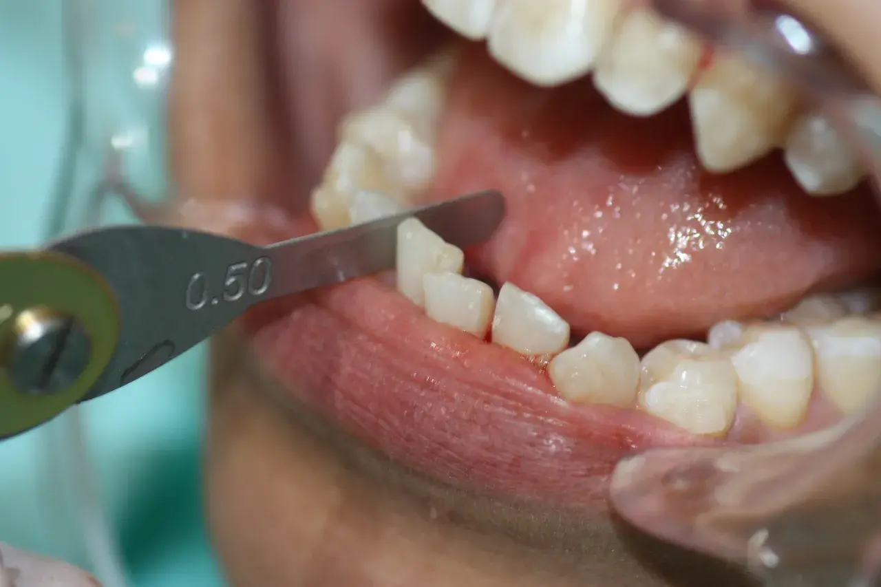 Herramienta dental mide 0.50mm para limar dientes, parte del proceso de tratamiento con Invisalign.