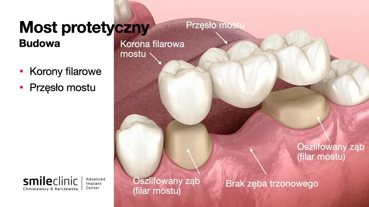 Most protetyczny z przęsłem i koronami filarowymi, uzupełniający brak 2 zębów obok siebie.