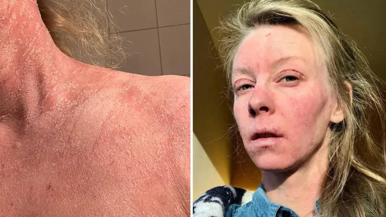 Bilden visar en person med svår hudirritation och fjällning på halsen och ansiktet, möjligen som en reaktion på thiamidol biverkningar.
