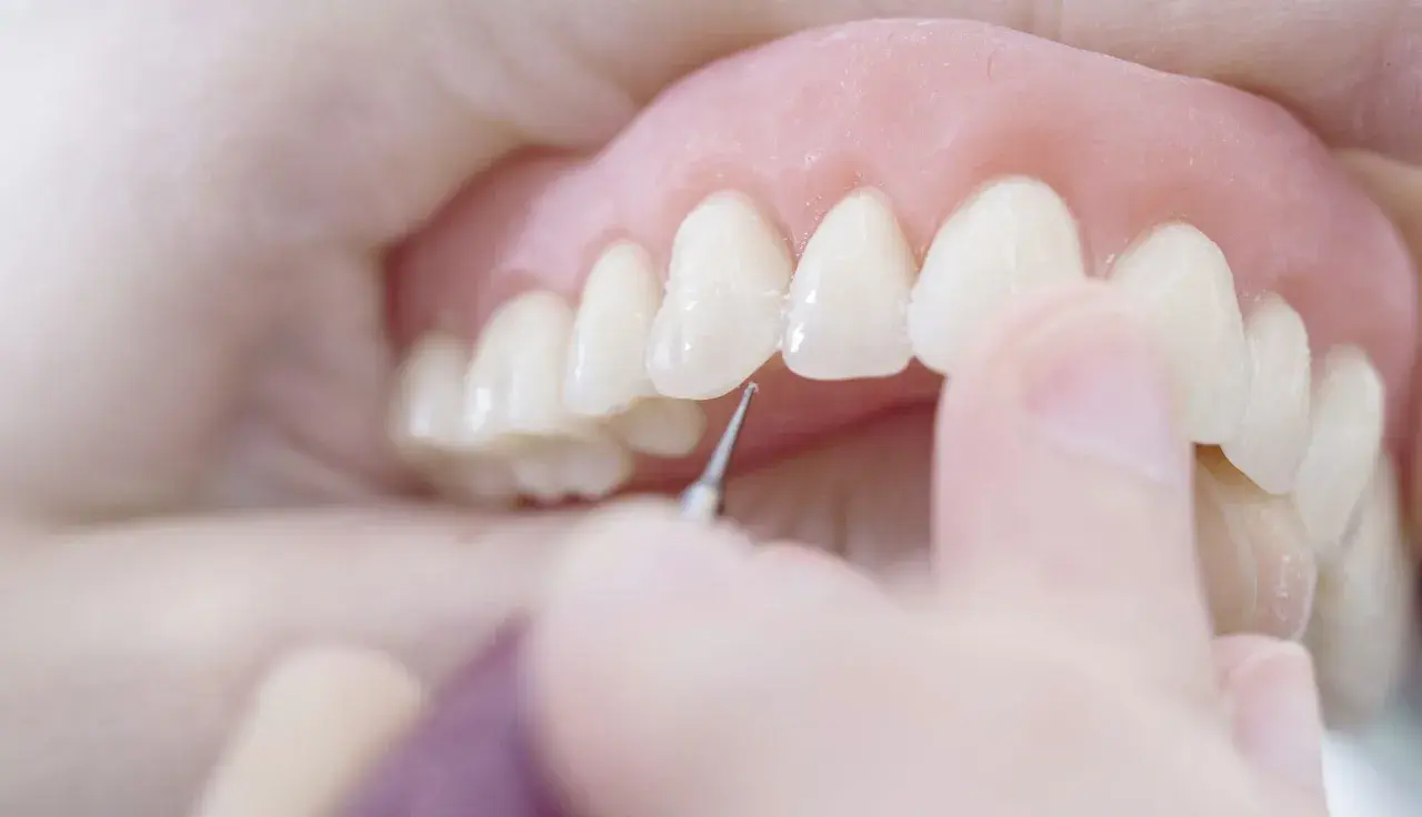 Dettaglio di una dentiera che viene posizionata, un passo importante per abituarsi alla dentiera e ritrovare un sorriso smagliante.