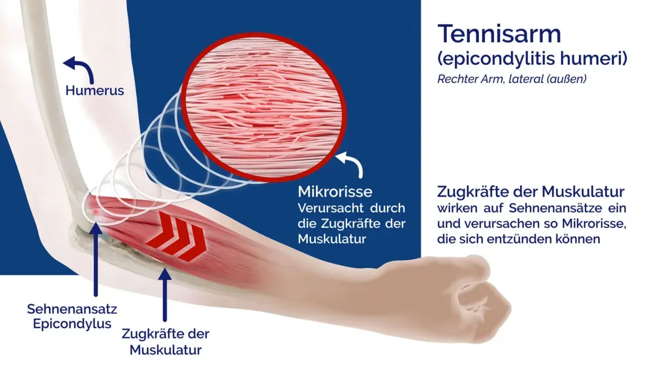 Illustration zeigt den rechten Ellenbogen bei einem Tennisarm. Zugkräfte der Muskulatur verursachen Mikrorisse am Sehnenansatz.