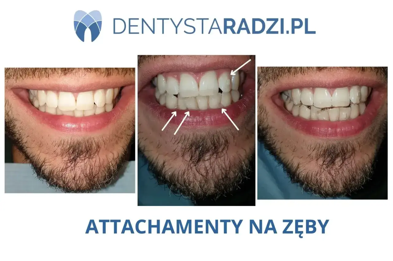 Przed i po: czy nakładki na zęby działają? Widoczne zbliżenie na uśmiech mężczyzny z widocznymi nierównościami, a następnie z nałożonymi przezroczystymi nakładkami.