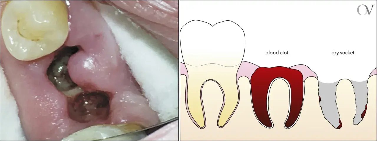Comparación de un diente con coágulo sanguíneo y alveolitis seca, mostrando los síntomas de alveolitis seca.