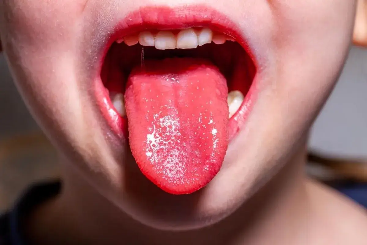Bocca di bambino con lingua rossa e un po' bianca, possibile sintomo di streptococco.