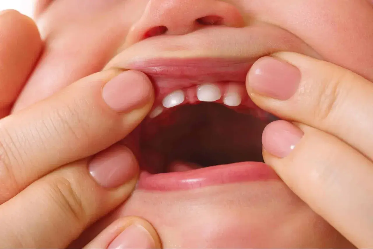 Bebé con frenillo labial inferior inflamado, mostrando sus pequeños dientes.
