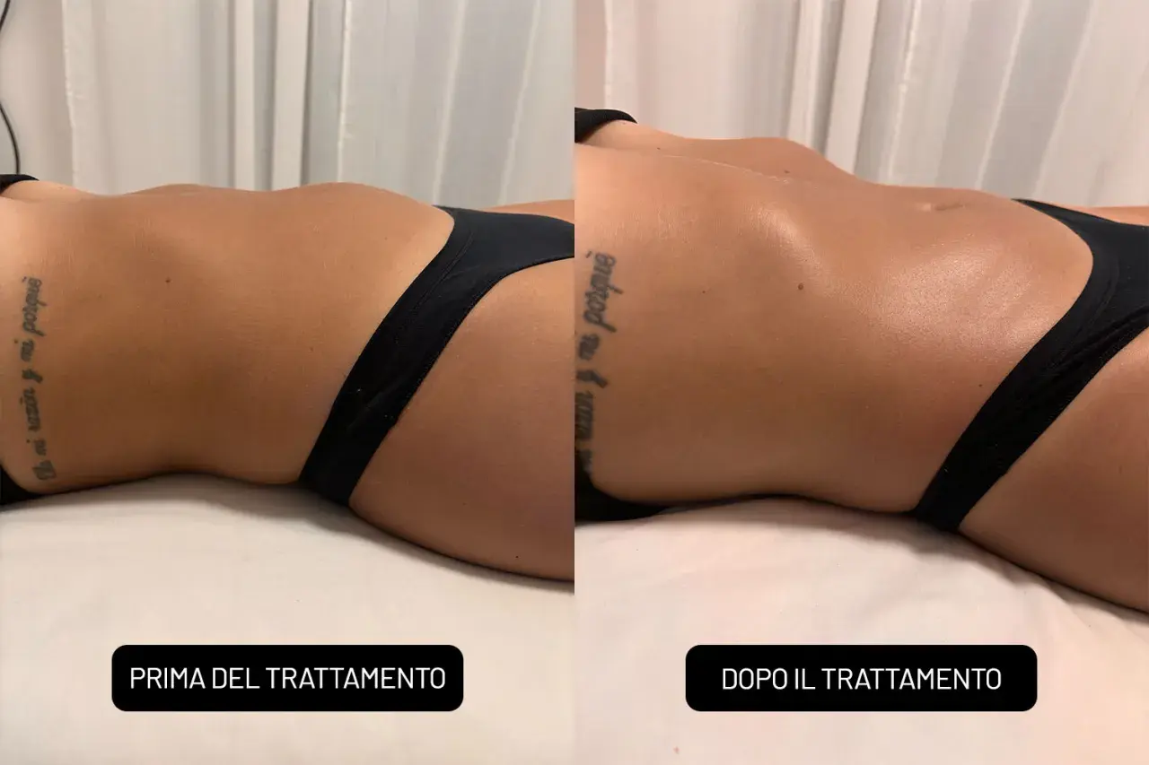 Confronto prima e dopo un massaggio rassodante: la pelle appare più tonica e liscia.