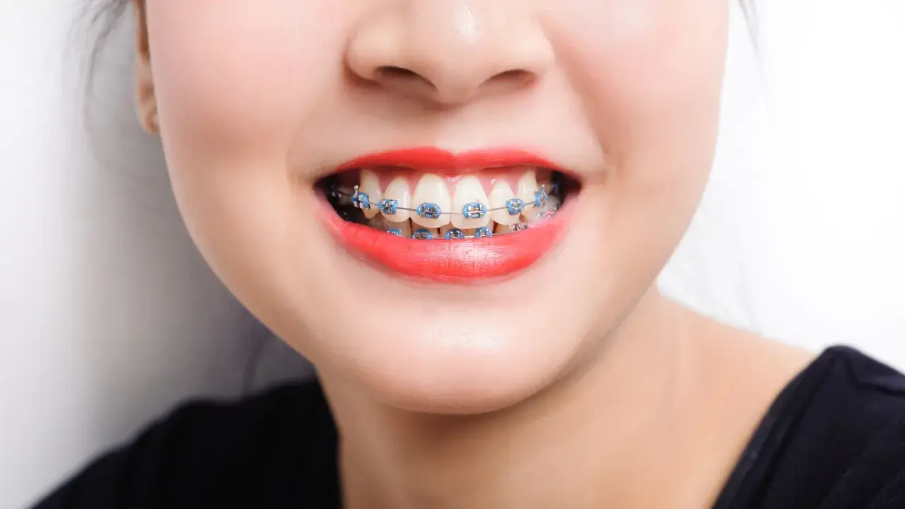 Sonrisa con brackets azules. A veces, los ataches me hacen heridas, pero la sonrisa vale la pena.