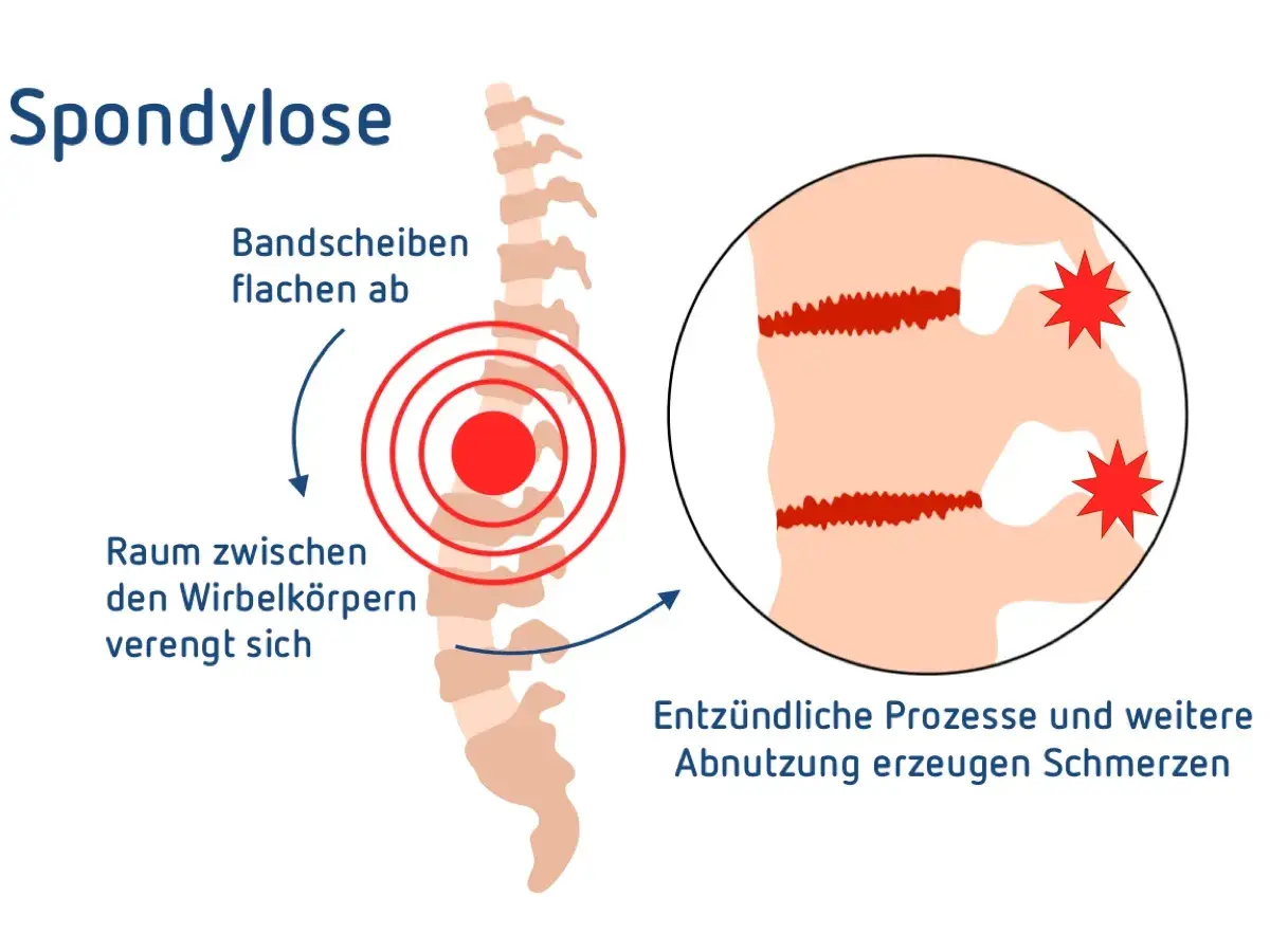 Spondylose LWS: Bandscheiben flachen ab, Raum zwischen Wirbelkörpern verengt sich. Entzündliche Prozesse und Abnutzung erzeugen Schmerzen.