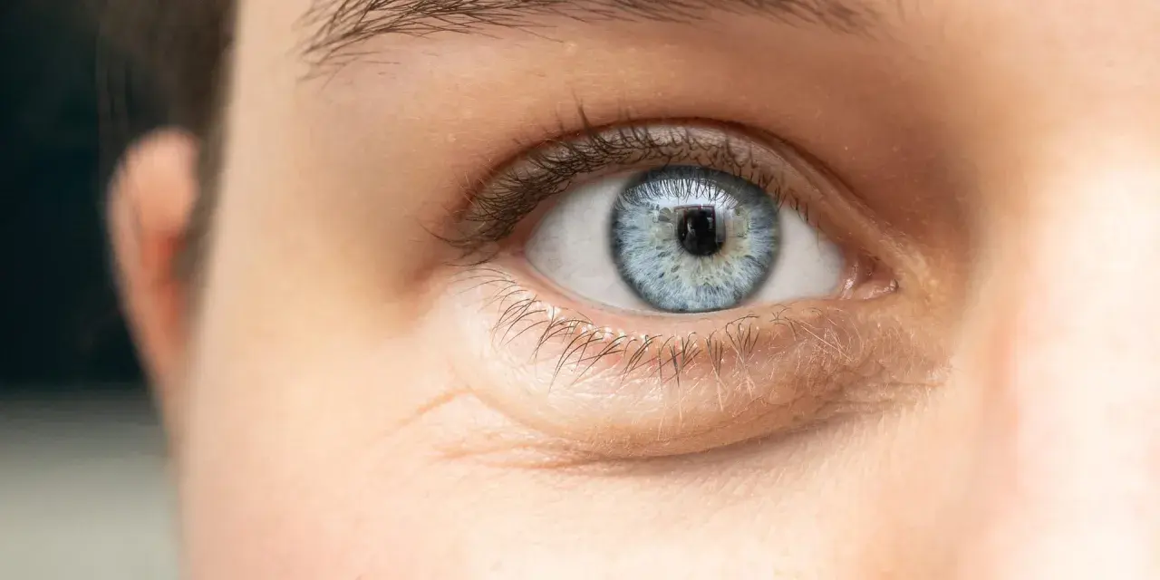 Ojo azul con ojeras hinchadas y finas arrugas bajo el párpado inferior.