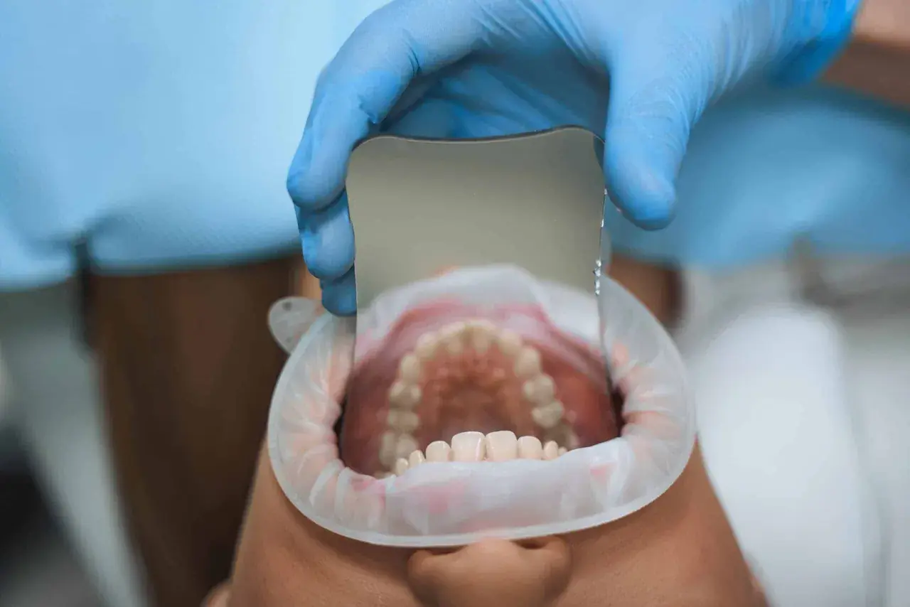 Dentista examina dientes con espejo, detectando una caries leve.