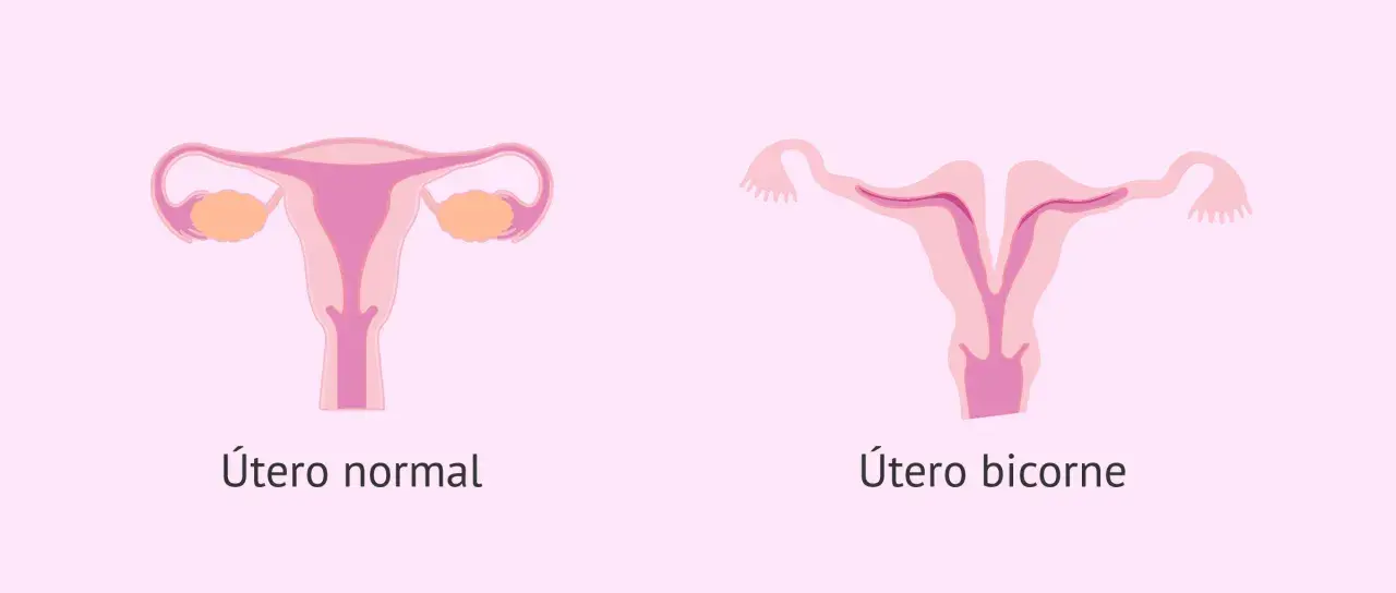 Comparación visual de un útero normal y un útero bicorne, mostrando la forma dividida de este último.