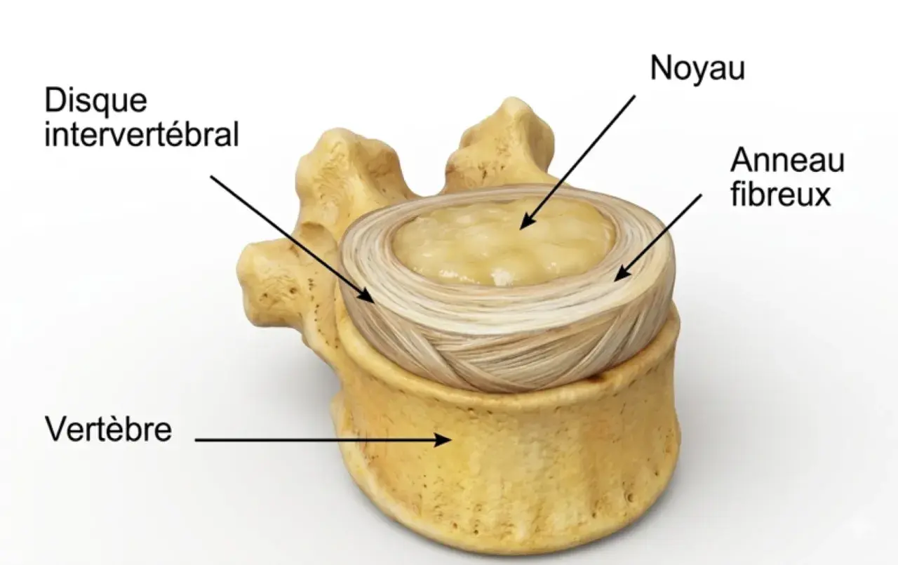 Disque intervertébral, noyau et anneau fibreux, montrant la structure d'une vertèbre, essentielle pour comprendre une hernie discale.