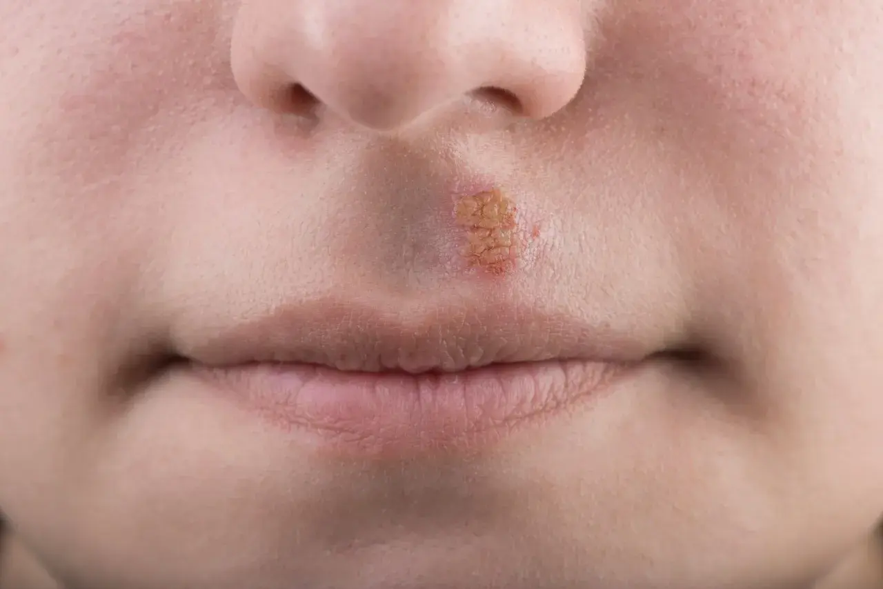Herpes mento: lesione cutanea con crosticine giallastre e arrossate sul labbro superiore, vicino al naso.