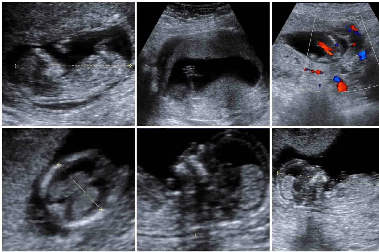 Ecografie fetali: immagini di un feto in utero, con misurazioni e flussi sanguigni. Si nota un movimento che potrebbe indicare un singhiozzo feto.
