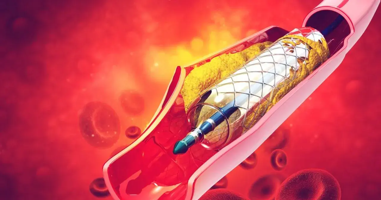 Stent w tętnicy z blaszką miażdżycową i krwinkami czerwonymi.