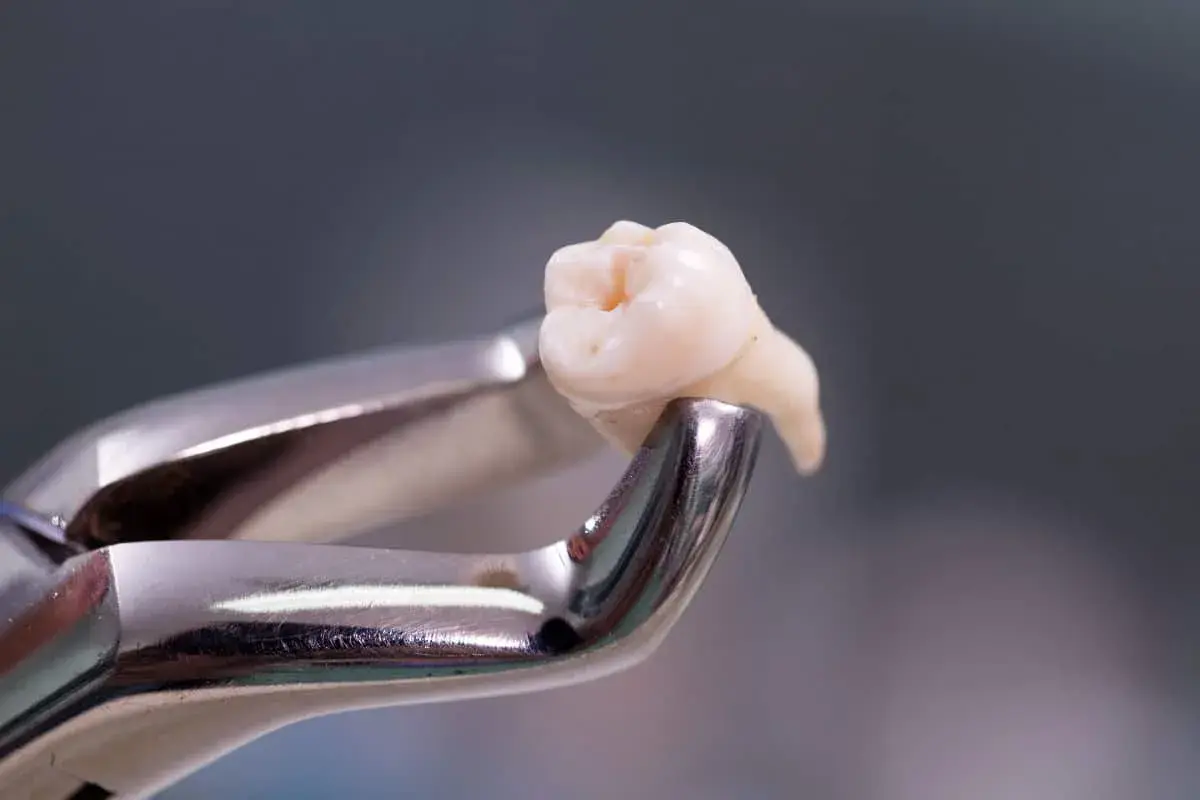 Pinzas dentales sujetan un diente extraído, resultado de una exodoncia dental.