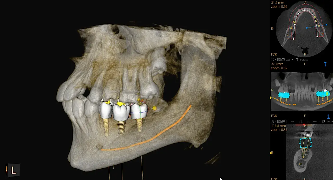 Trójwymiarowa tomografia stożkowa szczęki z widocznymi implantami zębowymi i planowaną ścieżką nerwu.