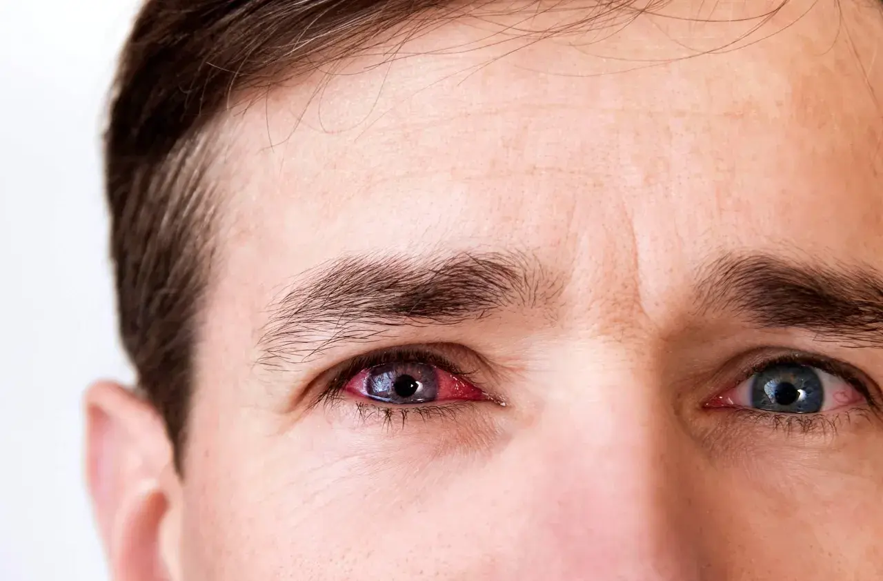 Gros plan sur les yeux d'un homme, l'un d'eux est rouge et irrité, présentant des symptômes de conjonctivite.