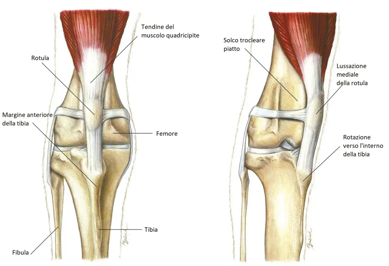 Illustrazione anatomica del ginocchio di un cane, che mostra la rotula e il femore. A destra, la lussazione mediale della rotula, una condizione che può richiedere un intervento chirurgico. Il costo dell'intervento per la lussazione rotula cane varia.
