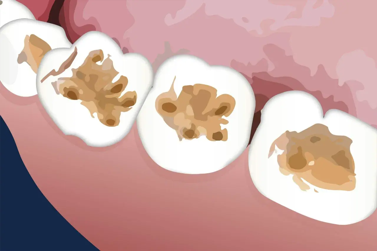 Denti con cavità interne, una carie interna non visibile che distrugge la struttura dall'interno.