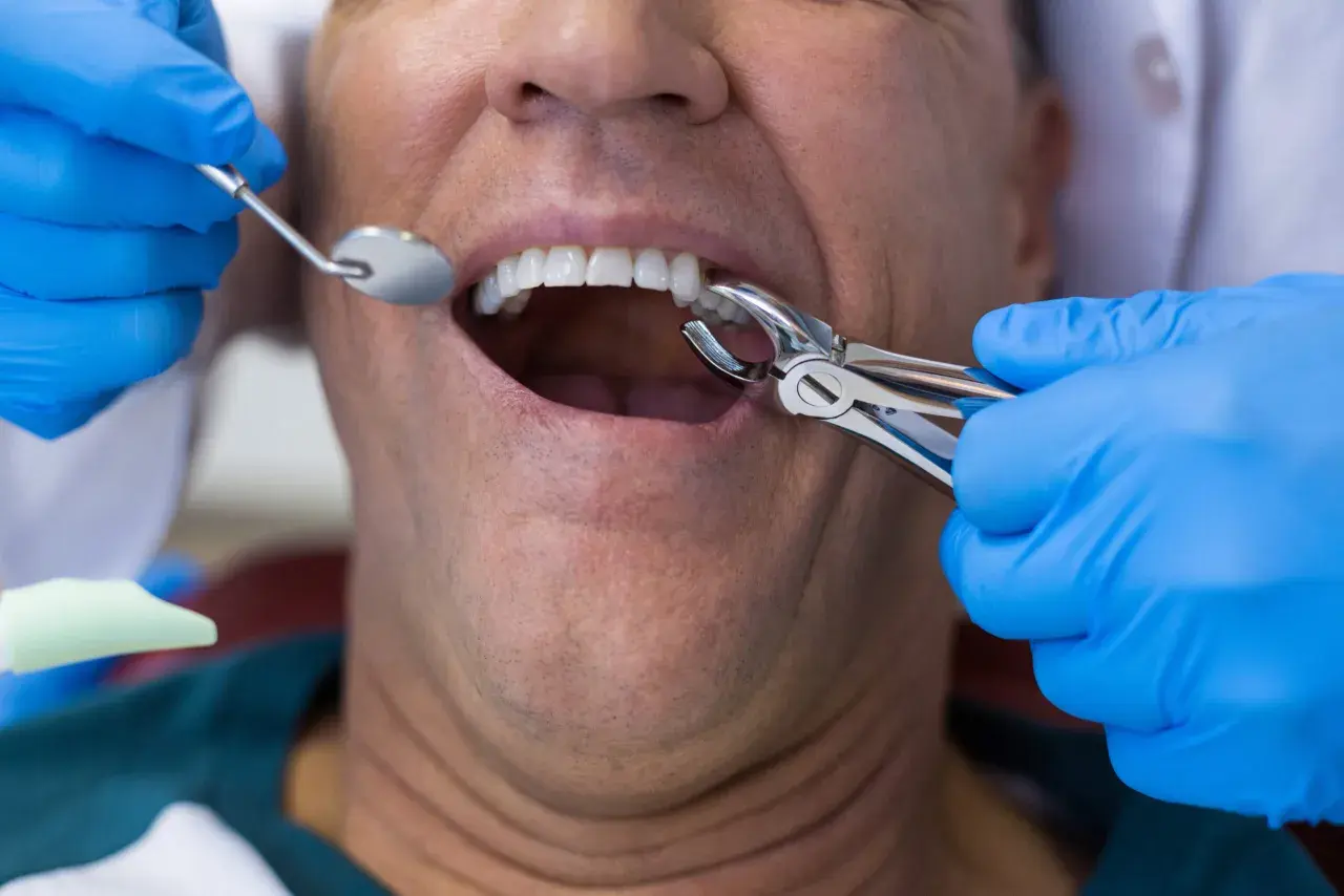 Dentysta w niebieskich rękawiczkach używa kleszczy do ekstrakcji zęba. Pacjent ma otwarte usta, widać jego zęby.