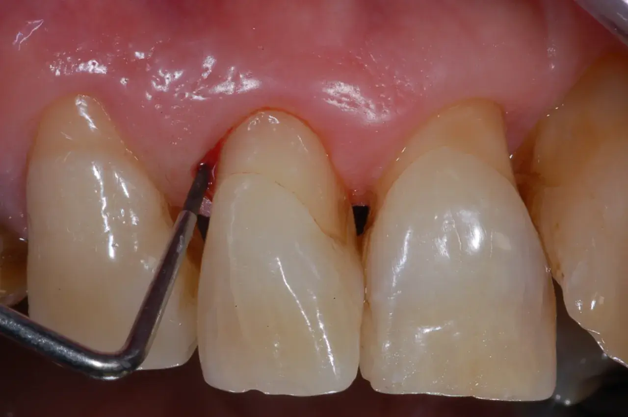 Strumento dentale che causa sanguinamento gengive vicino a un dente.