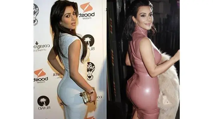 Kim Kardashian: Prawda o operacjach plastycznych i "efekcie BBL"