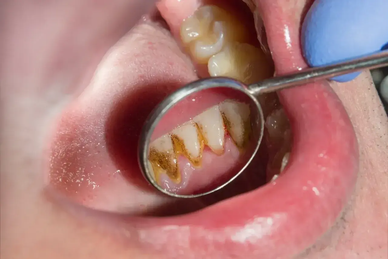 Widok zęba w lusterku dentystycznym, gdzie kamień nazębny sam odpada, odsłaniając zdrowszą powierzchnię.