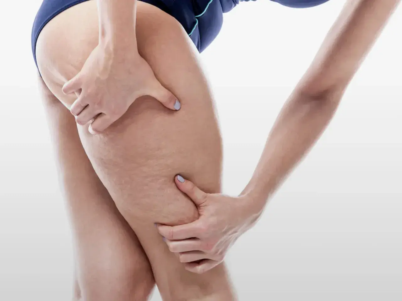 Mani che stringono la coscia, evidenziando la pelle con segni di cellulite, forse un effetto di 10 kg di ritenzione idrica.