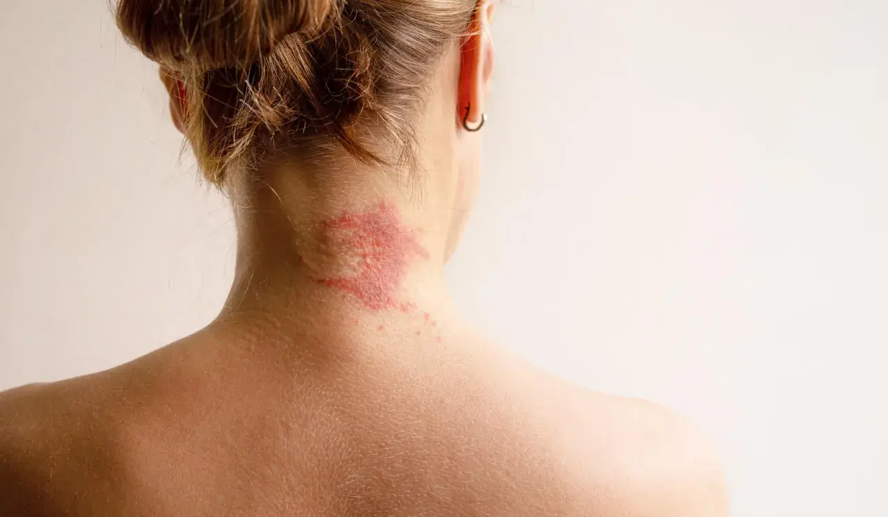 Roter, schuppiger Ausschlag am Nacken, der auf Neurodermitis hindeutet. Suche nach Neurodermitis Hausmittel zur Linderung.