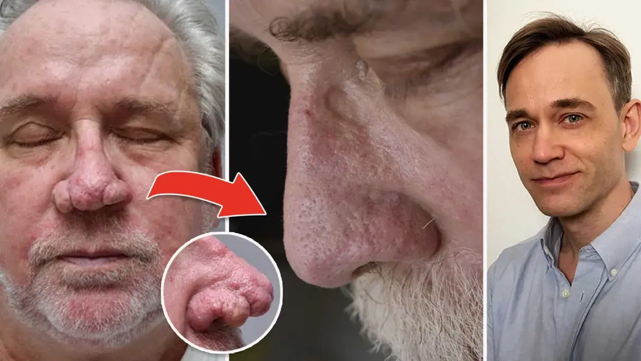 Före- och efterbilder som visar en mans näsa med rhinophyma och en läkare. Möjlig rhinophyma behandling.