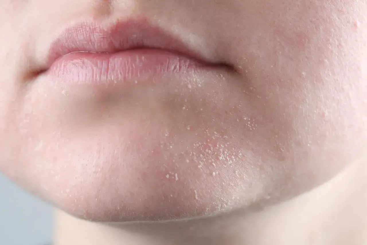 Gros plan sur des lèvres et un menton montrant une peau sèche et squameuse, signe potentiel d'une cause de peau sèche.