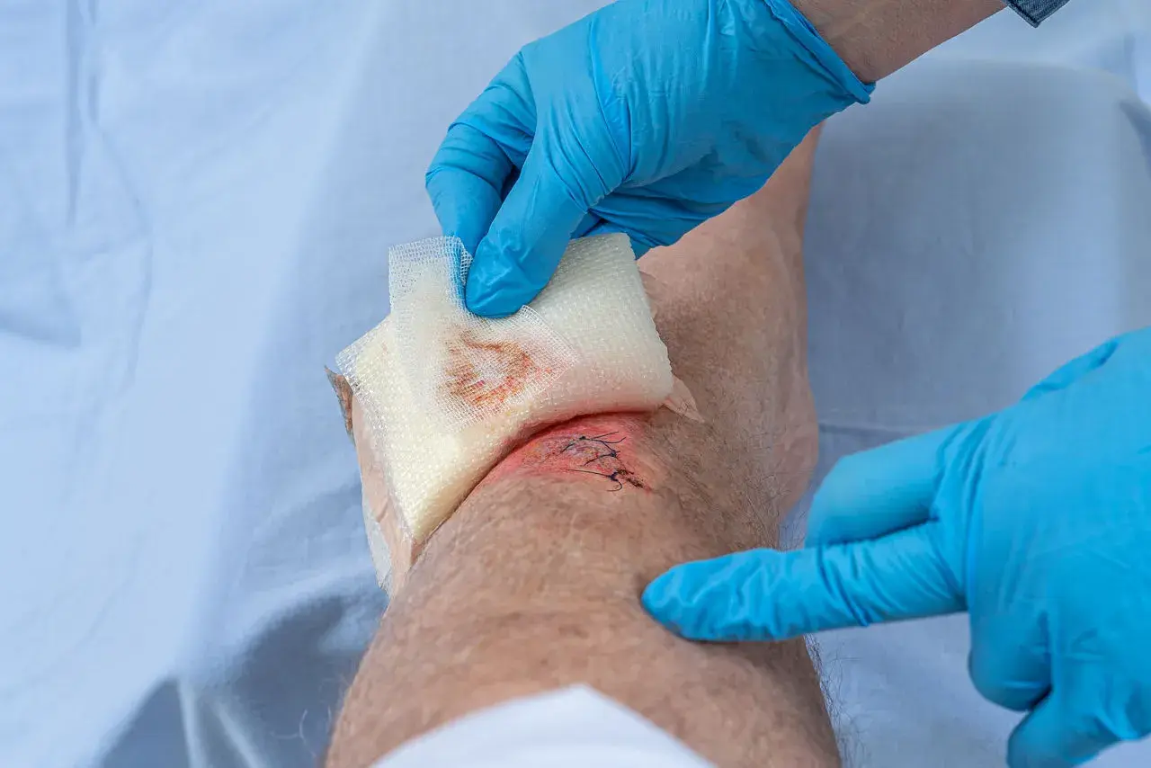 Ein Bein mit einer genähten Wunde und Anzeichen schlechter wundheilung wird mit einem Verband versorgt.
