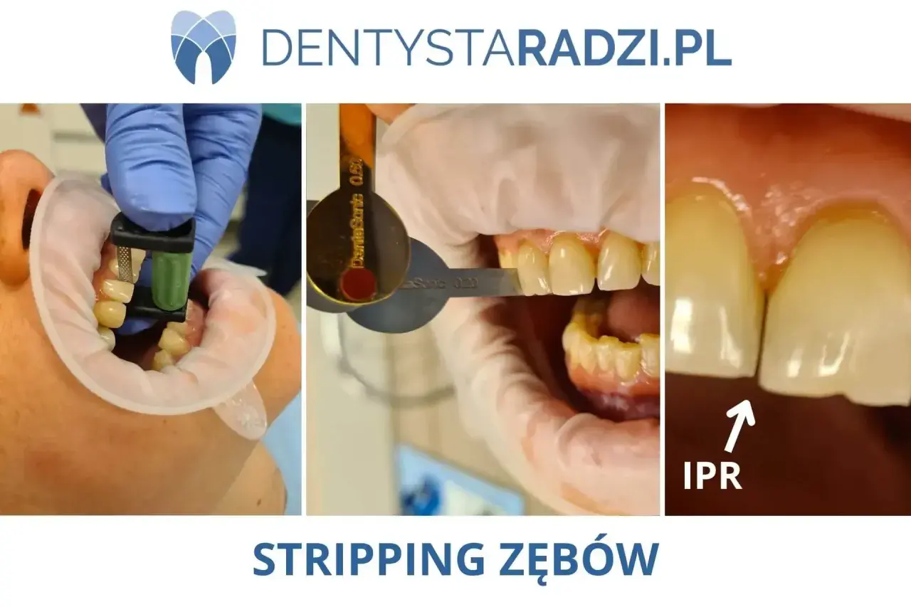 Zabieg stripping zębów: stomatolog używa narzędzi do delikatnego modelowania przestrzeni międzyzębowych (IPR).