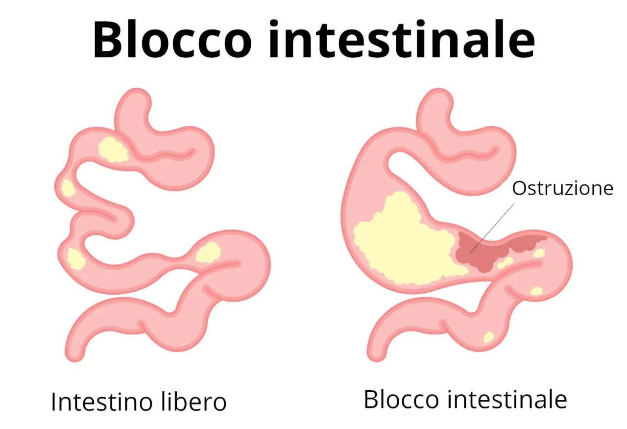 Illustrazione di un intestino libero e di un blocco intestinale, che spiega perché non riesco ad andare in bagno.