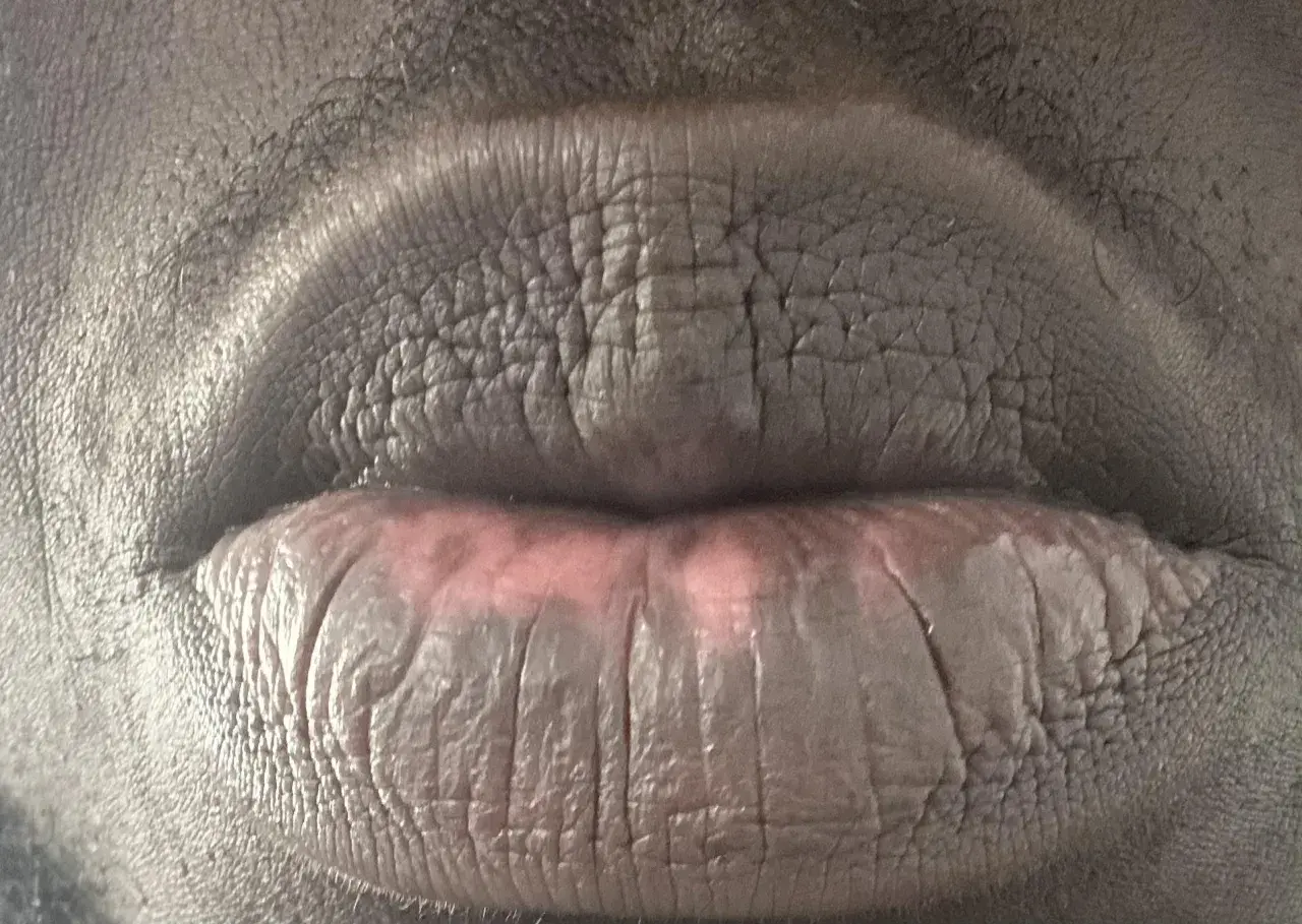 Labios agrietados y con manchas, evidencia de manchas en los labios por fumar.