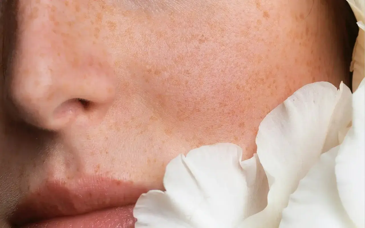Piel con pecas y un pétalo blanco. Las ceramidas para que sirve: restauran la barrera cutánea, hidratan y protegen.