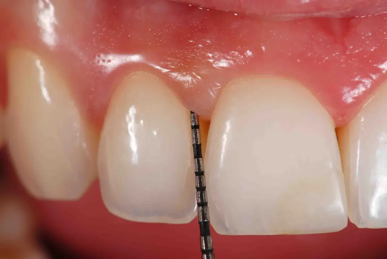 Sonda periodontal mide la profundidad de la encía. La piorrea se pega si no se cuida.
