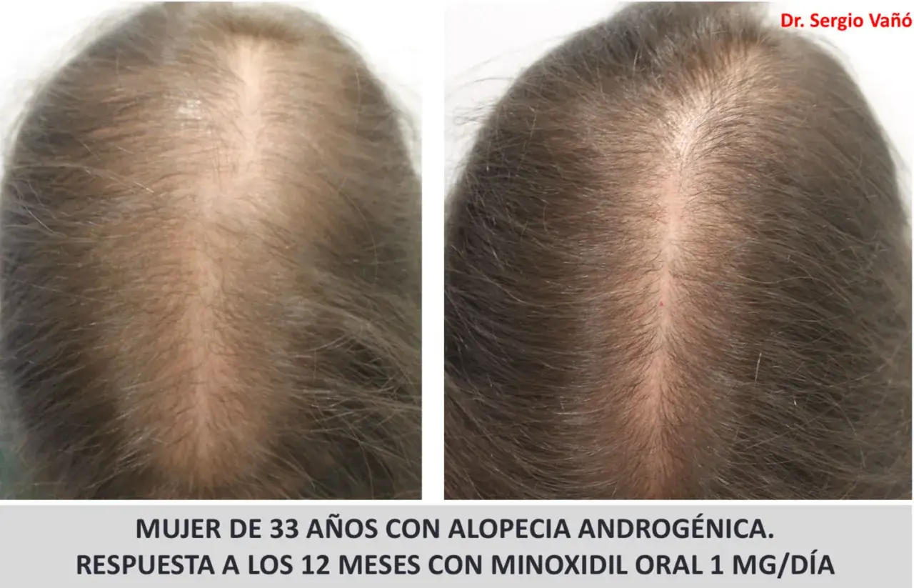 Comparativa de cabello de mujer de 33 años con alopecia androgenética, mostrando mejora tras 12 meses de tratamiento con minoxidil oral.