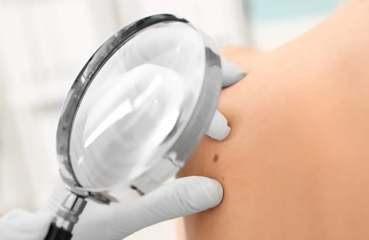 Examen d'un grain de beauté sur un mamelon, possible apparition durant la grossesse.
