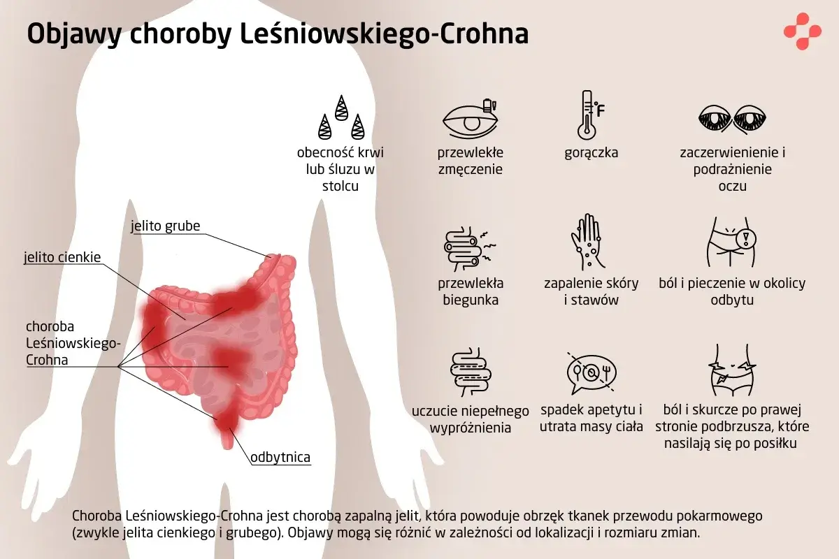Choroba Leśniowskiego-Crohna: objawy obejmują zmęczenie, gorączkę, biegunkę, ból brzucha, problemy ze skórą i oczami.