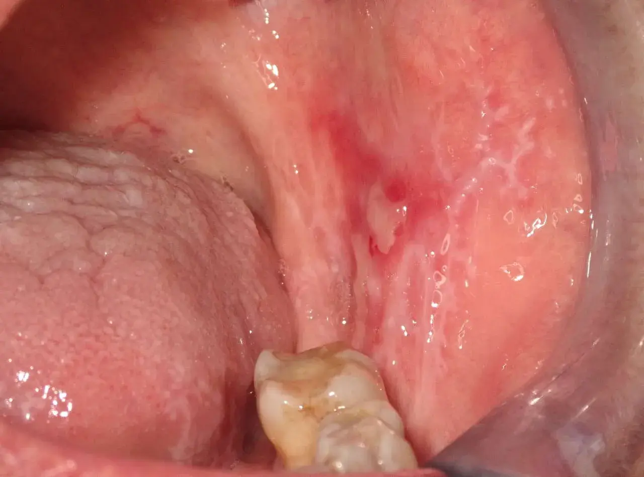 Lesioni biancastre e rosse nella bocca, indicative di lichen planus orale, in attesa di terapia.