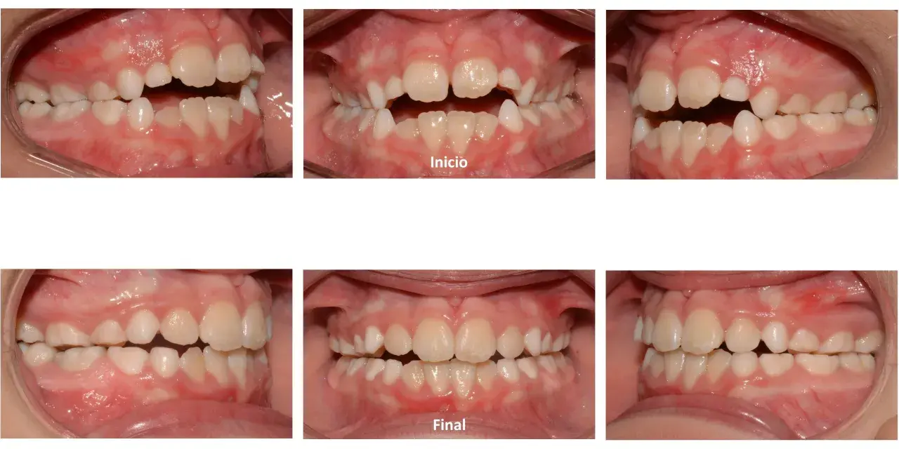 Niño con mordida abierta antes y después. Las imágenes muestran la corrección de la alineación dental, logrando una oclusión perfecta.